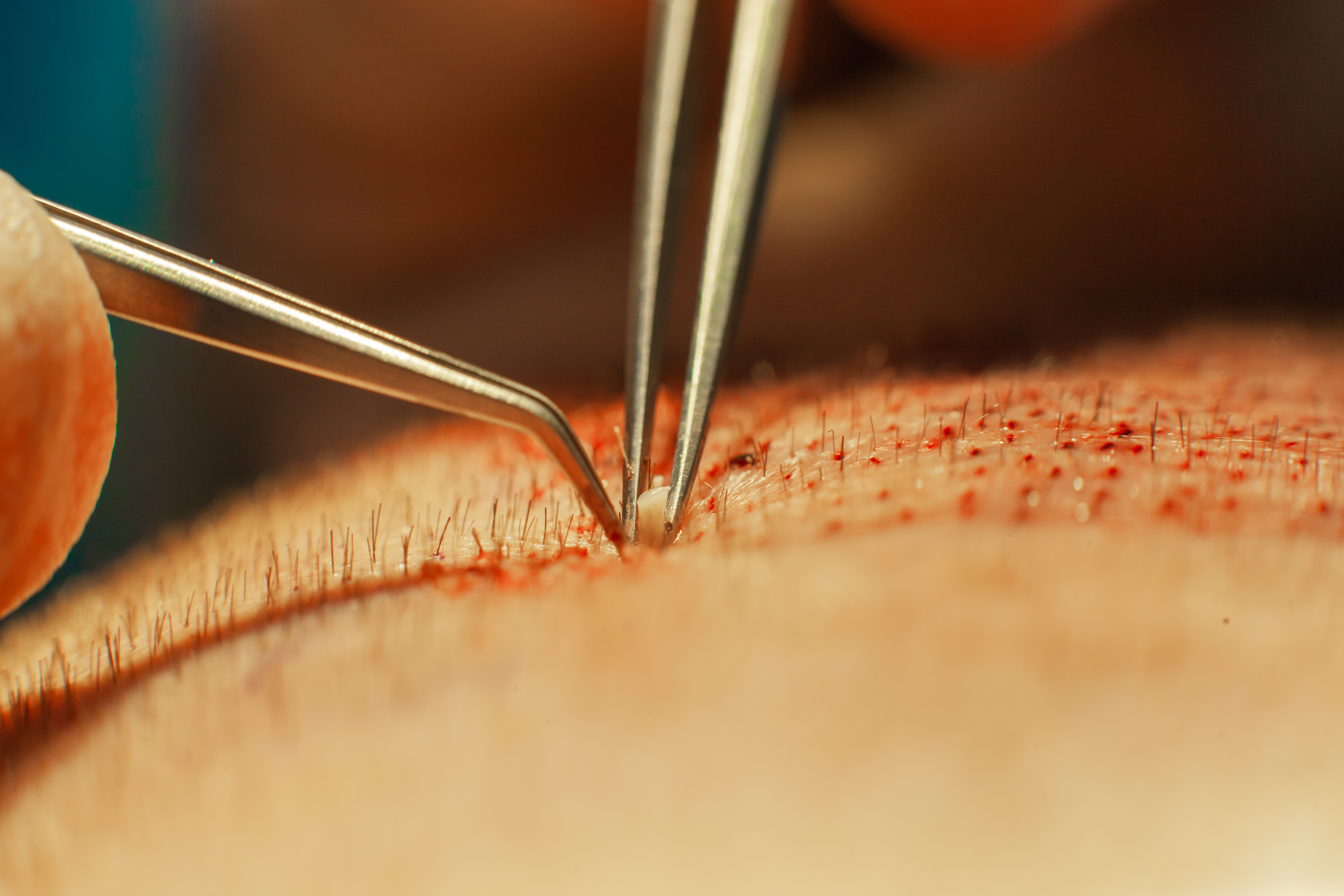 Macrophotography of a hair bulb transplanted into a hairless area. Baldness treatment. Hair transplant. Surgeons in the operating room carry out hair transplant surgery. Surgical technique that moves hair follicles from a part of the head caída del pelo